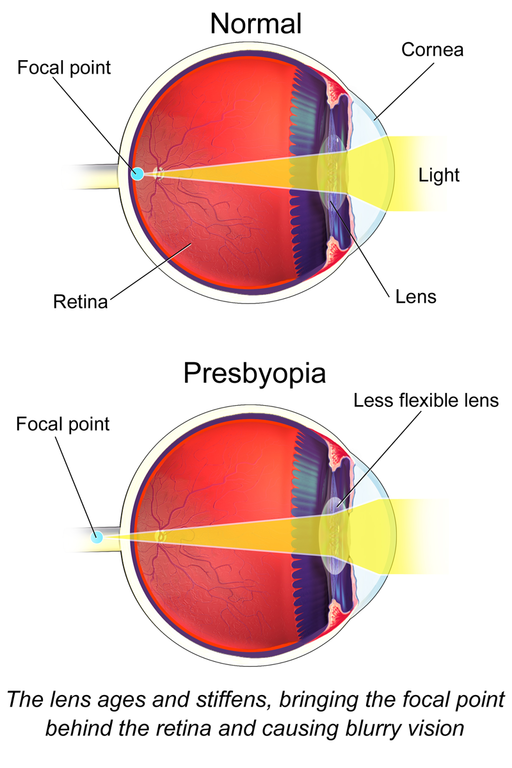 Presbyopia