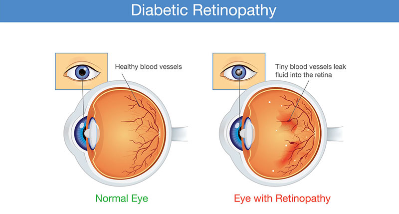 diabetic-retinopathy-adult-pediatric-eyecare-local-eye-doctor-near-you.jpg