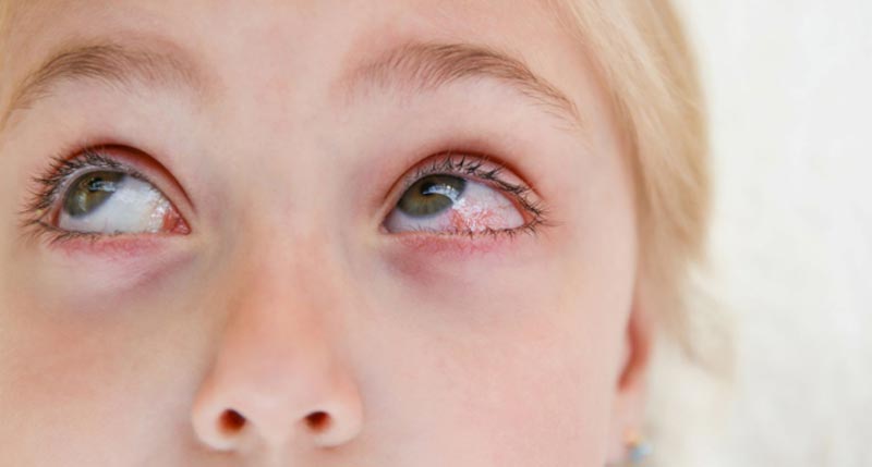pink-eye-adult-pediatric-eyecare-local-eye-doctor-near-you.jpg